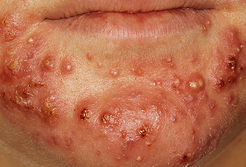 Acne - A severe case of acne.