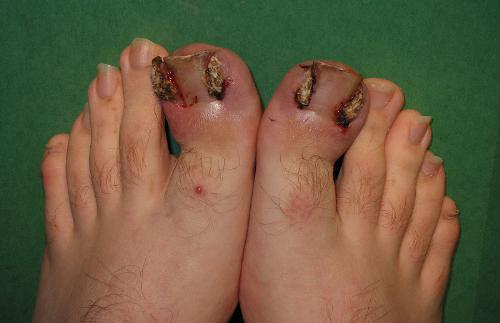 Ingrown toenails - Had this problem on one toe but it was not that bad! yikes!