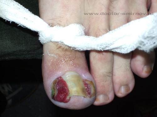 Ingrown toenail - It amazes me people wait so long to get this taken care of! yikes!