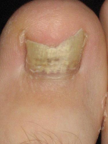 Toe Fungus - My oldest brother has it and doesn't do anything about it! Weird!
