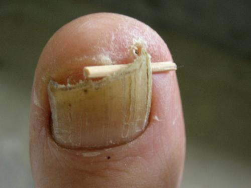 Ingrown toenail - Going to the extreme to avoid an ingown toenail! Just use a toothpick!