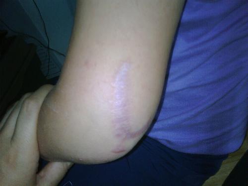 My daughter's scar - My daughter fell through a bottom-floor window and she was rushed to Emergency. This is why I carry a well-stocked first aid kit everywhere I go.