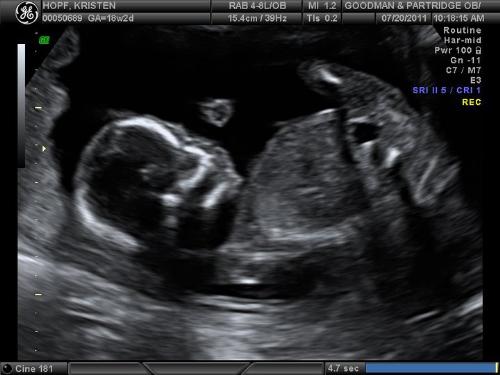 Ultra Sound - Kristen's ultrasound photo