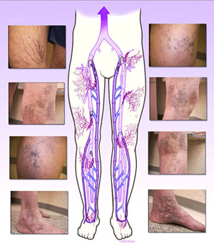 Varicose veins -  Varicose veins are veins that become enlarged and tortous.