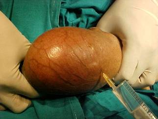 hydrocele surgery - this was the pic of my hydrocele surgery .