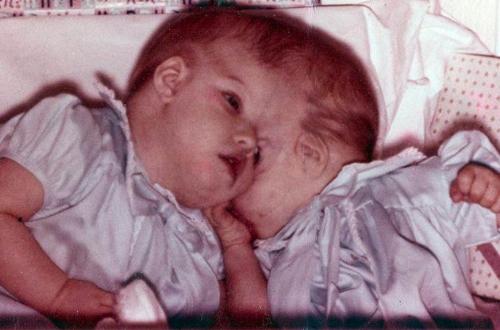 Conjoined twins - 50th Birthday of conjoined twins 