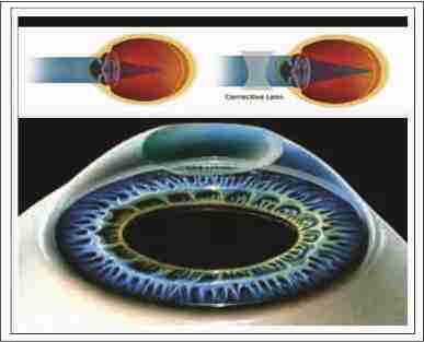 Contact lenses can treat Myopia - Myopia is a visualization problem that affects a huge number of people, particularly children. There has been dispute in the medical community about whether or not the evolution of myopia can be decelerated. Research has established that Rigid Gas Permeable (RGB) contacts were capable to slow down the growth of myopia in over 25% of children wearing them. There are a number of signs a child will give to display that they are suffering from this illness. Children who are anguish from myopia may complain of headaches on a regular basis. They may also suffer from eyestrain when they are trying to stare at objects just a few feet away from them. The immense majority of children who have myopia are not capable to clearly see distant objects. If you notice that your child is regularly moving close to objects in order to see them, this is a bad sign. If you notice any of the things stated above, you should check with your doctor or pediatrician immediately. It is best to let children to wear these contacts when they are liable enough to handle them. It is vital for parents to teach them the significance of caring for their lenses, cleaning them as scheduled. While it is not possible with present technology to treat myopia, RGP contacts are effective in slowing down the growth of this illness.