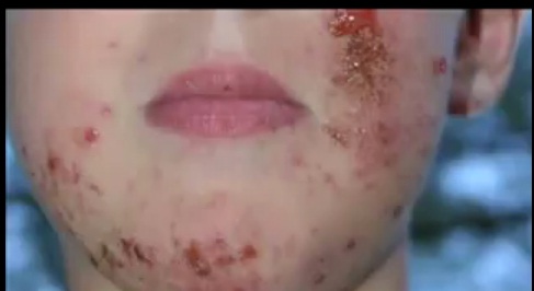 Skin allergy - eczema