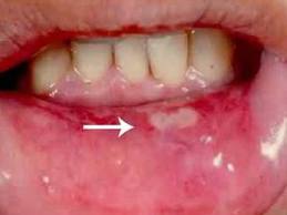heated the mouth - I often heat the mouth. I usually mouth sores, painful and burning when eating.
