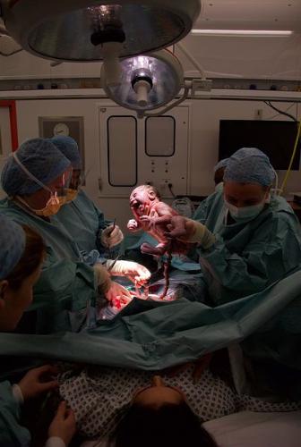 c-section operation  - c-section operation c-section operation 