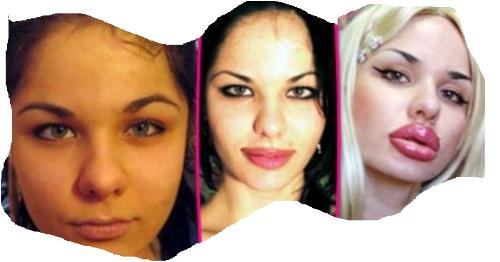After Several Injections - These pictures show the transformation of her lips after several injections. After Several Injections - These pictures show the transformation of her lips after several injections.
