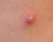 Pimple - I find that putting toothpaste on a pimple gets rid of it faster.