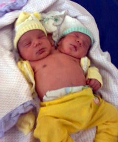 Twins with single heart and two heads - Conjoined child with one heart