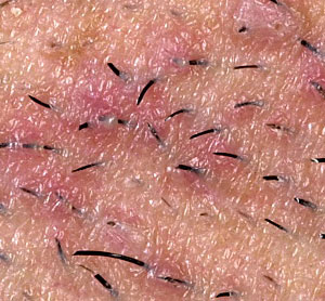 Ingrown Hair - It is a condition where the hair curls back or grows sideways into the skin leaving red bumps or even skin inflammations.