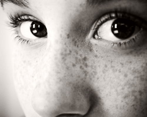 Freckles - Freckles look bad on the face.