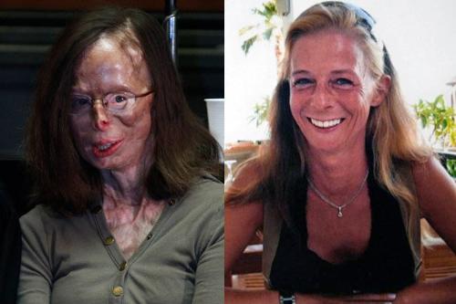 Picture of Patricia Lefrace - This is the picture of Patricia Lefranc the girl who Incredible bravery of acid attack