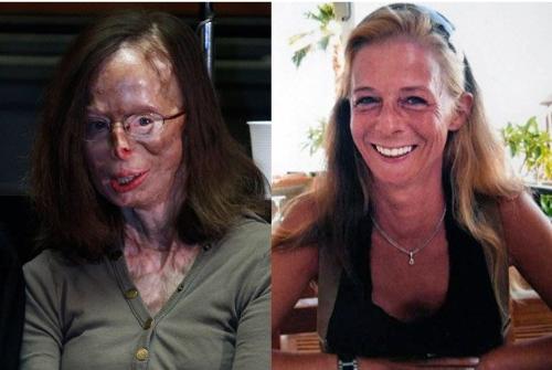 Incredible bravery of an acid attack victim - She is Patricia Lefranc, a 48year old lady who survived an acid attack by her jilted lover Incredible bravery of an acid attack victim - She is Patricia Lefranc, a 48year old lady who survived an acid attack by her jilted lover
