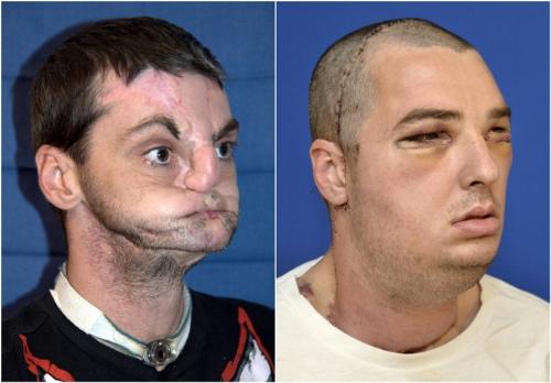 US Dr. transplant gives man new teeth and face - A man whose surgery is successful. 