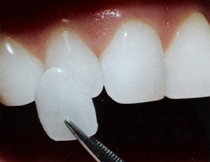 veener - veener to brighten or straighten teeth veener - veener to brighten or straighten teeth