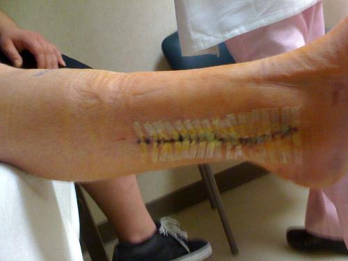 My Scar Annoys me - The scar on my ankle that resulted from two surgeries annoys me more than anything else I know of.