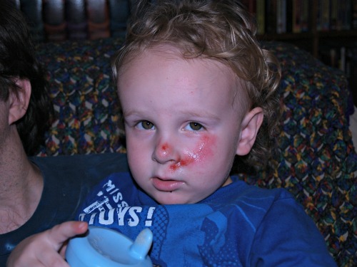 Owie - A portrait of a 2 year old boy with a scrape on his face where he landed on his face when he tripped over a rug and fell down.