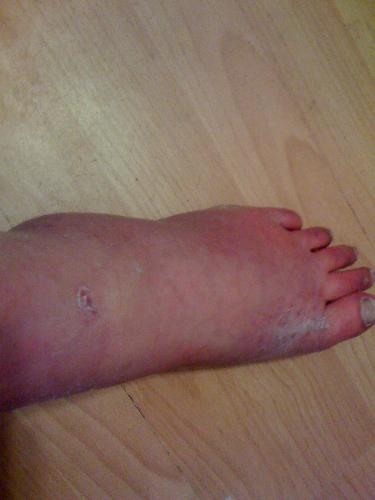 Raynauds disease of toes and feet, psoratic arthri - I hate living with this, but there is no cure for either of the problems that I have.