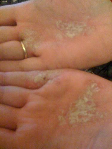 Psoriasis on the hands as well as on the front of  - Wish they would find a cure, as now having issues of opening things.
