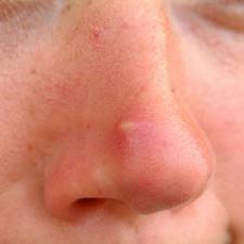 pimples - how to get rid of pimples?