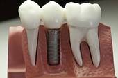 Tooth Implant - This is how an implant looks like