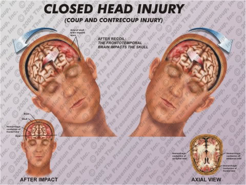 brain injury - http://www.google.com.ph/imgres?hl=en&safe=images&tbo=d&biw=1360&bih=629&tbm=isch&tbnid=JDDkMh7i8vUtFM:&imgrefurl=http://lifewithheadinjury.wordpress.com/2010/05/04/true-life-with-traumatic-brain-injury/&docid=1LN-Cb0-piuwrM&imgurl=http://lifewithheadinjury.files.wordpress.com/2010/05/1-hi-0004-closed-head-injury-ap_jpg.jpg&w=480&h=360&ei=9sewUOuLDOyiigeH9YCIBA&zoom=1&iact=hc&vpx=842&vpy=322&dur=1024&hovh=194&hovw=259&tx=144&ty=140&sig=106184282301326796811&page=1&tbnh=115&tbnw=135&start=0&ndsp=22&ved=1t:429,r:19,s:0,i:136
