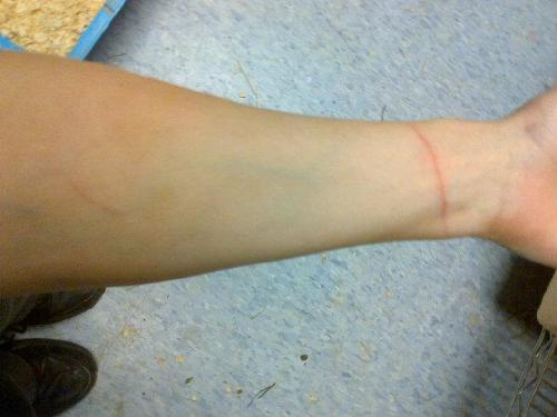 cut on arm