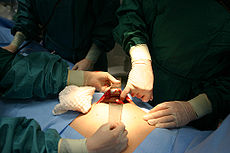 operation - operation to remove appendix