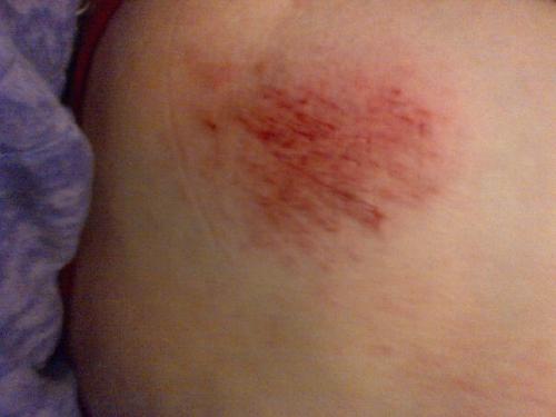 Battle Wound 1 - My cut I got walking