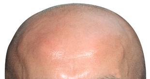 bald - Hair loosing problem