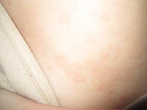 rash  - The rash that is on my back.