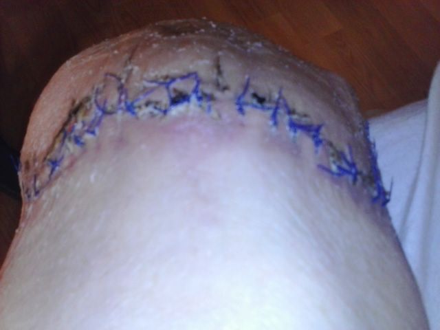Post amputation / scarring of my right leg (photo: me) Post amputation / scarring of my right leg (photo: me)