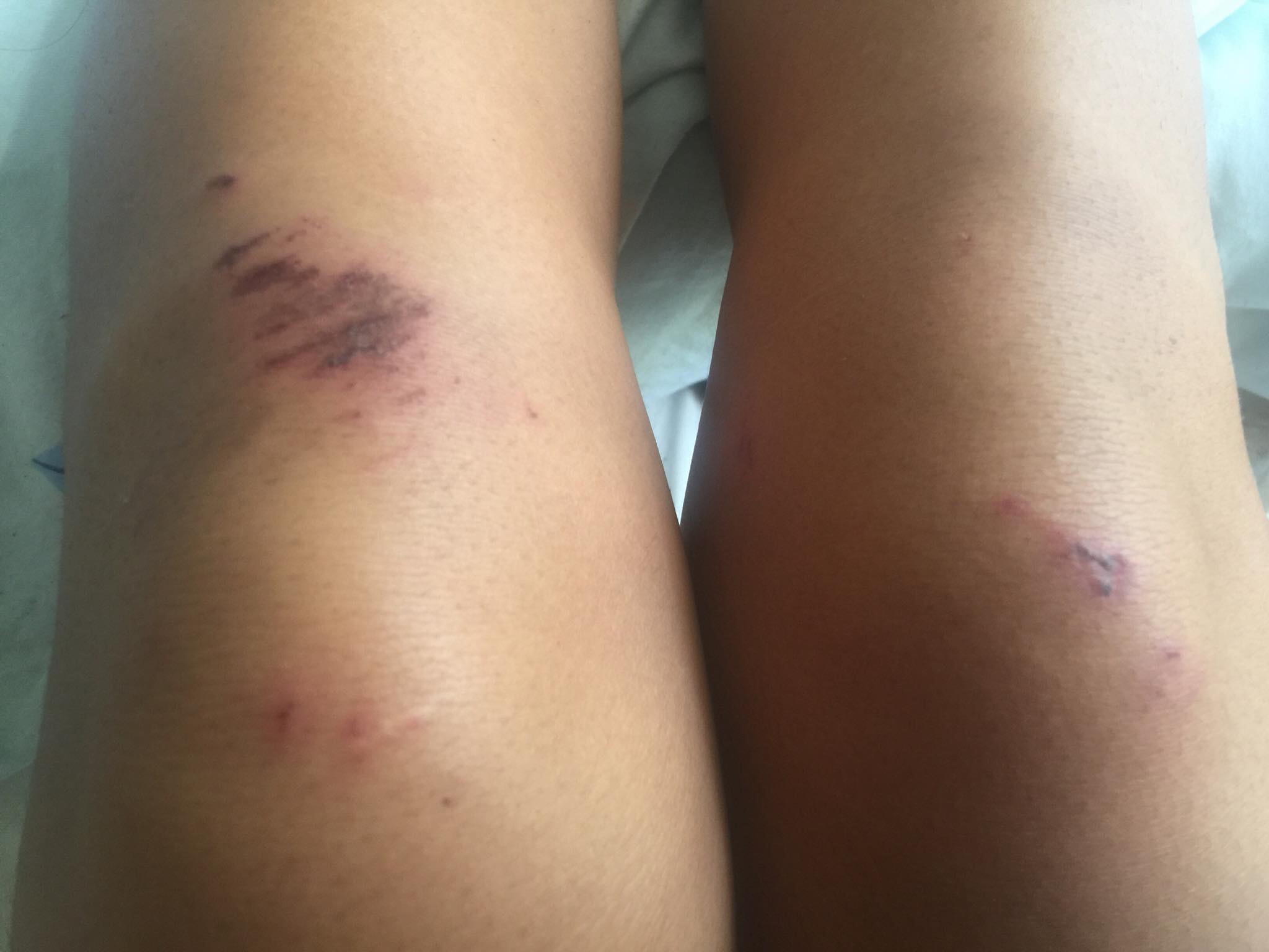 Injuries Injuries