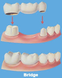 dental bridge, work done