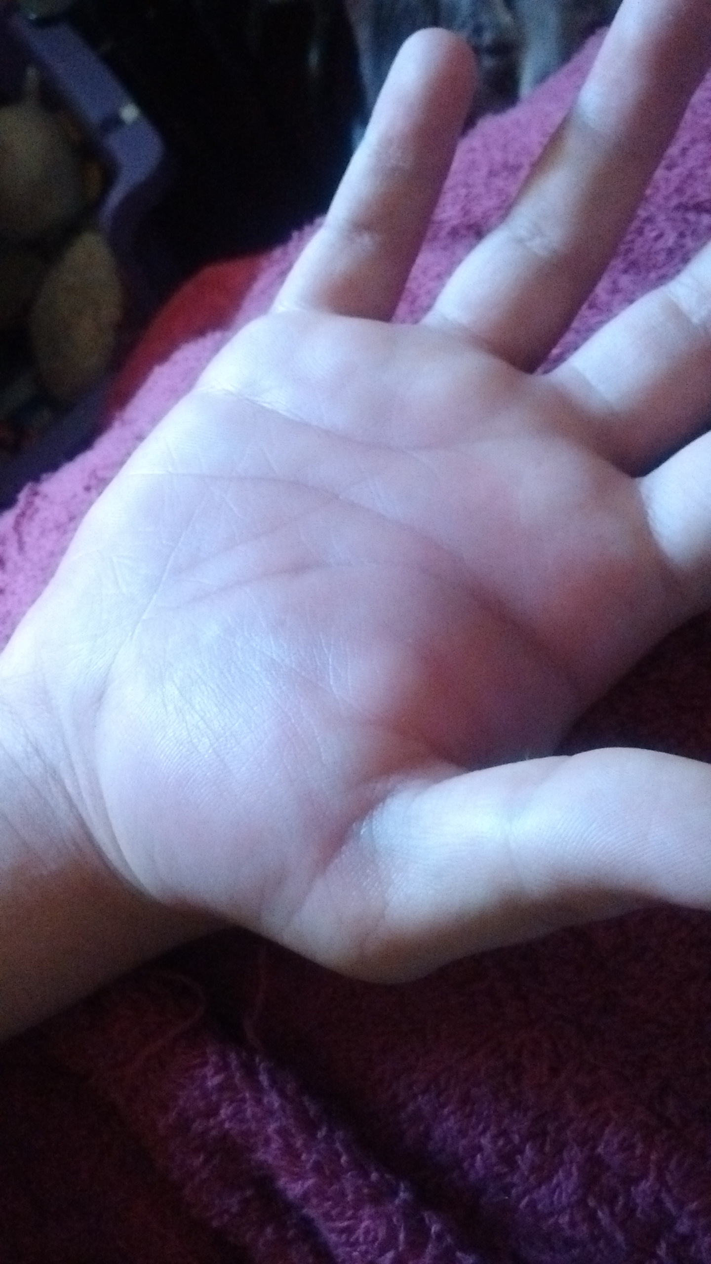 Justin's hand a few hours ago. Justin's hand a few hours ago.