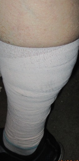 Unna boot on my good leg Unna boot on my good leg