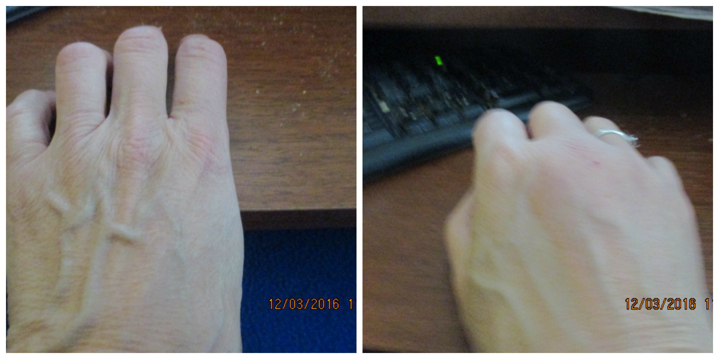 Left hand normal, right hand swollen. © 2016 Marsha Musselman Left hand normal, right hand swollen. © 2016 Marsha Musselman