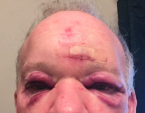My dad's face swollen from the injury