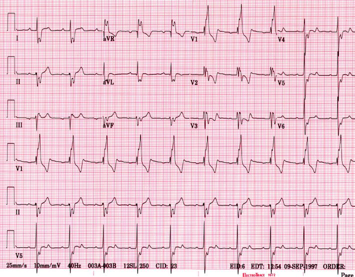 Экг 22. ЭКГ. Кардиограмма сердца. ЭКГ сердца. Бумага для кардиограммы.
