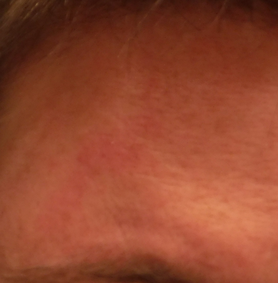 Mark on my head from banging into pipes the other day