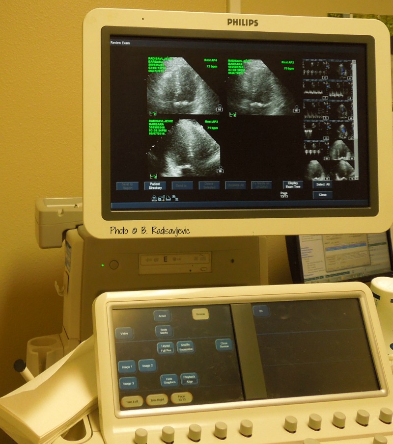 My Beating Heart -- An Ultrasound Picture from my Last Stress Test My Beating Heart -- An Ultrasound Picture from my Last Stress Test