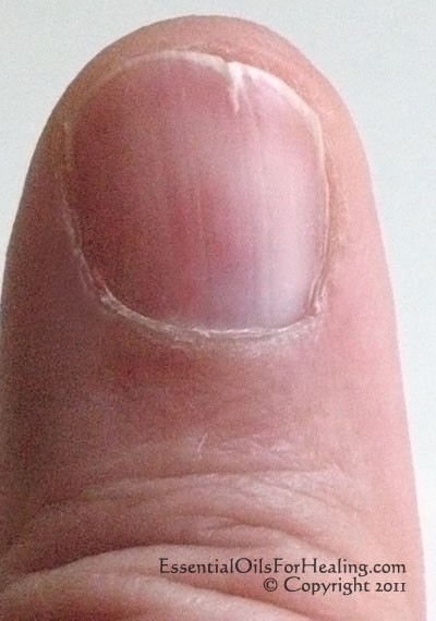 split nail