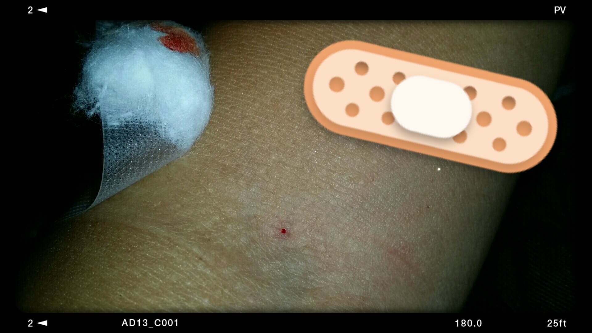 my left arm with the prick 