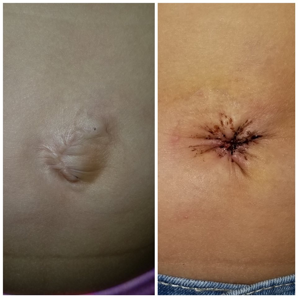 Picture is of granddaughter's "new" belly button Picture is of granddaughter's "new" belly button