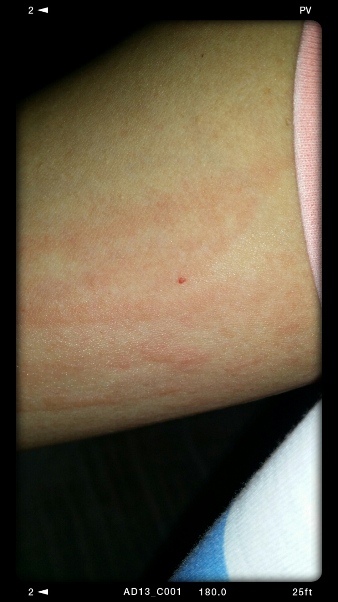 dermatographic rash