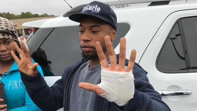 Austin Minott showing his wounded hands to the media in Long Island NY Austin Minott showing his wounded hands to the media in Long Island NY